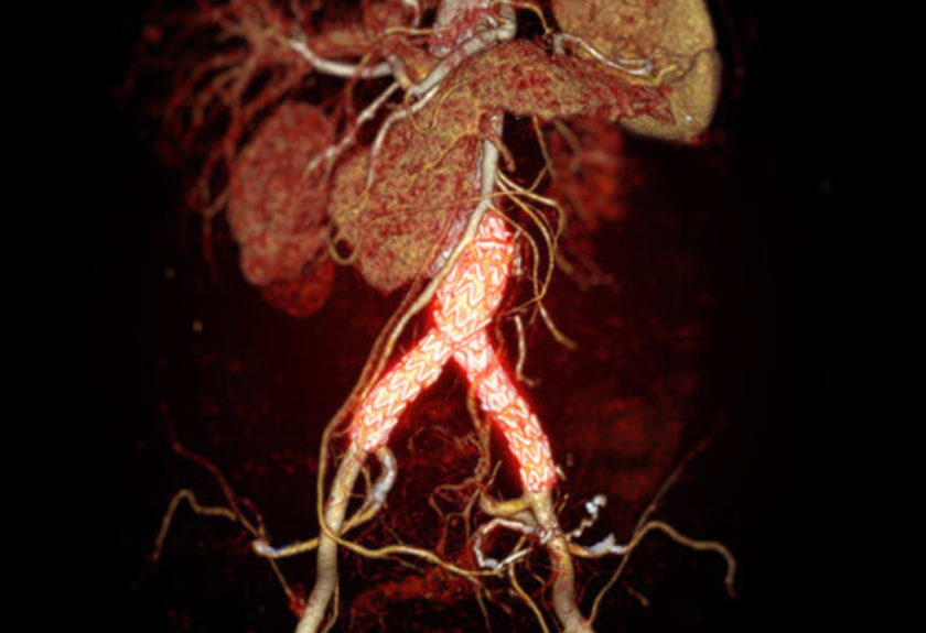 Abdominal Aortic Aneurysm in India