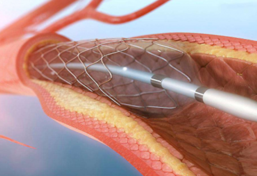 Angioplasty (PTCA)