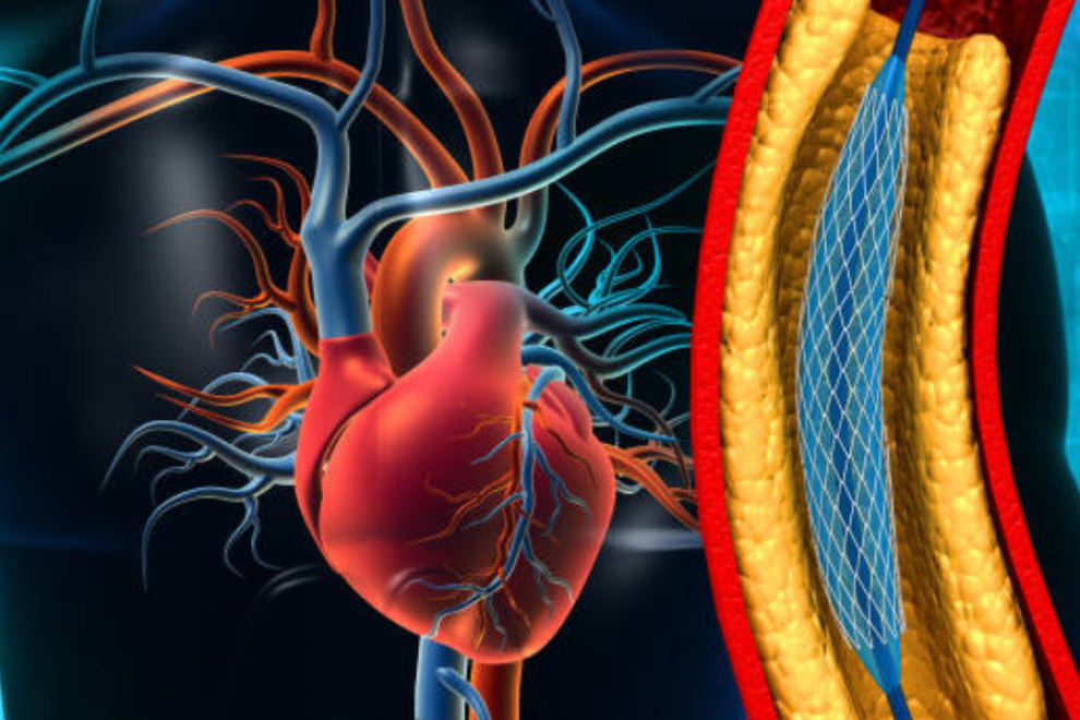 Angioplasty in India