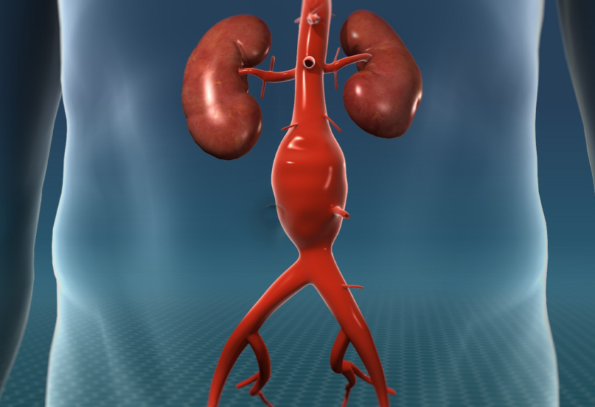 Aortic Aneurysm Repair Surgery