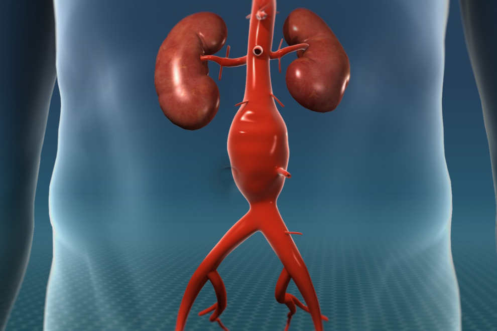 Aortic Aneurysm Repair Surgery