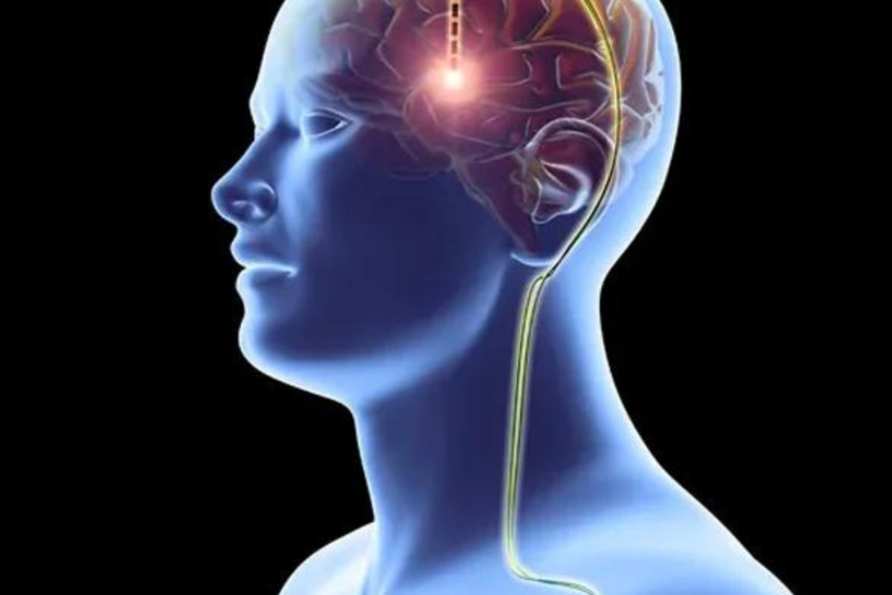 Deep Brain Stimulation (DBS)