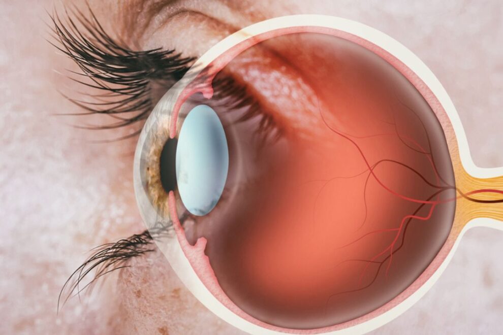 Retinal Detachment Surgery in India: Top Hospitals & Affordable Cost