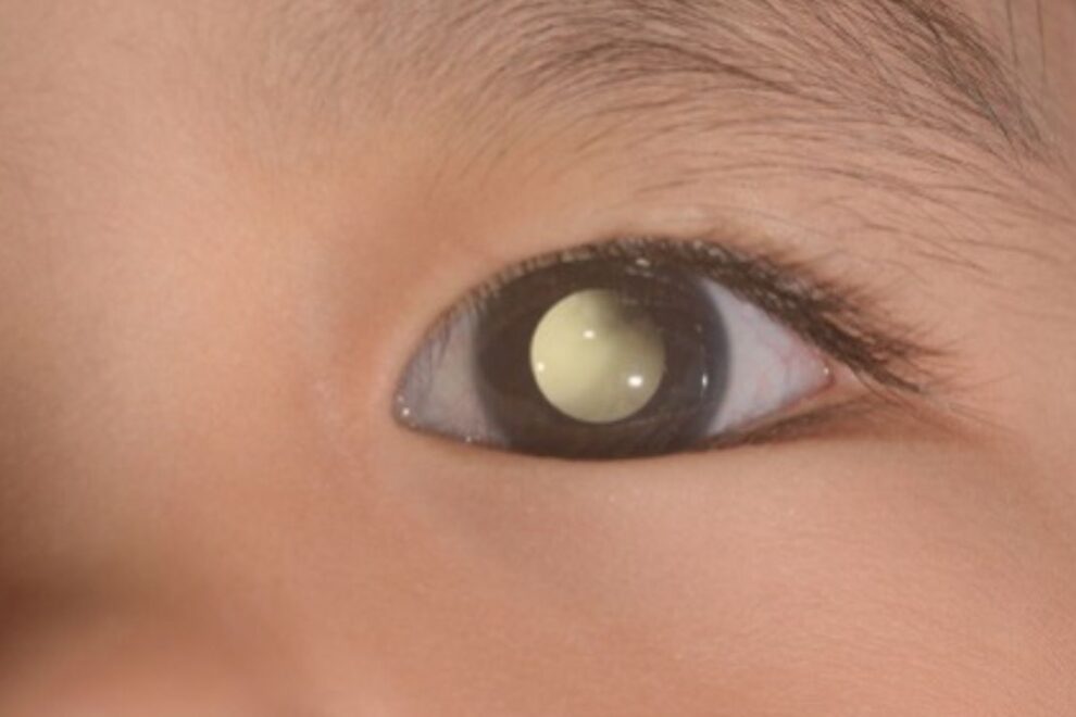 Retinoblastoma in India: Advanced Care & Affordable Options