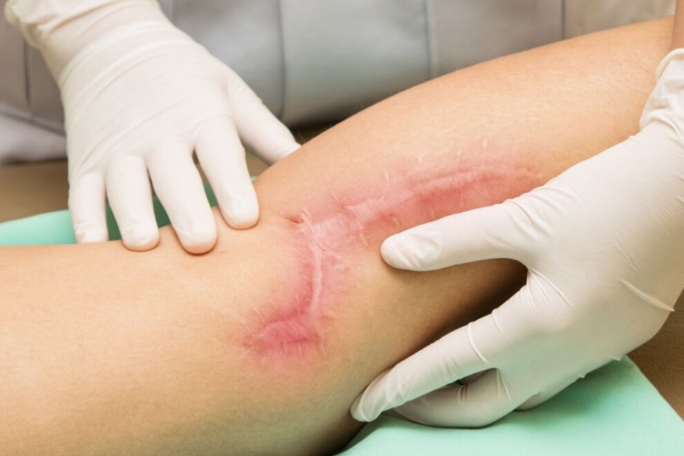 Scar Revision/scar Repair in India: Effective Treatments for Smooth Skin