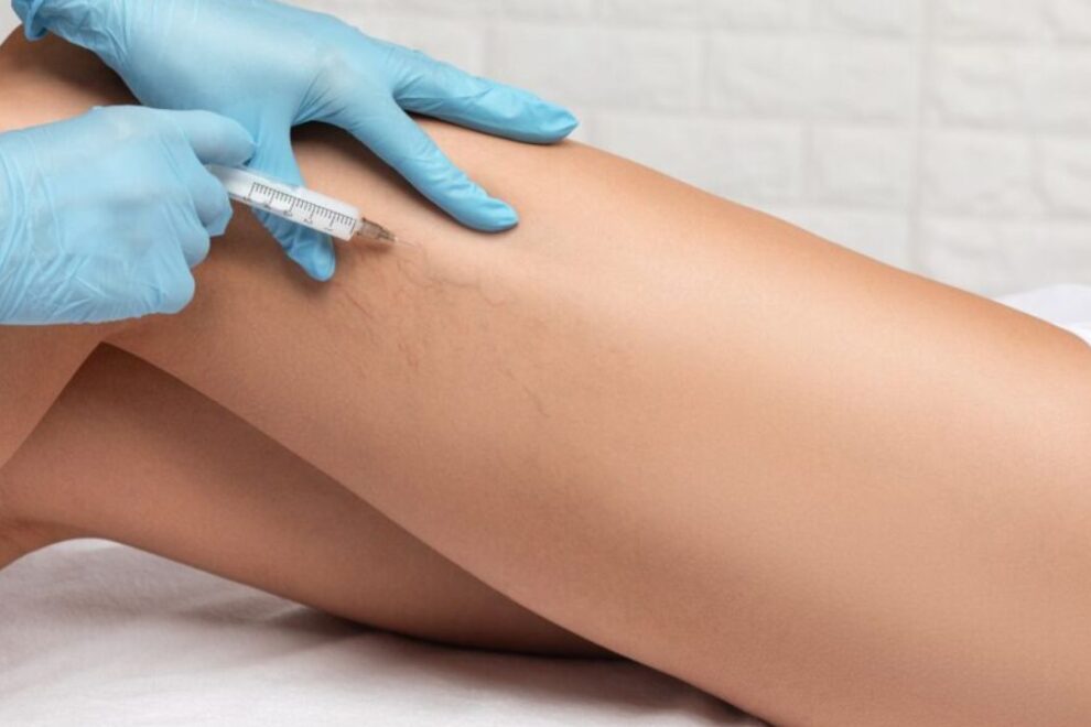 Sclerotherapy Varicose Veins Surgery in India: Cost, Benefits & Recovery