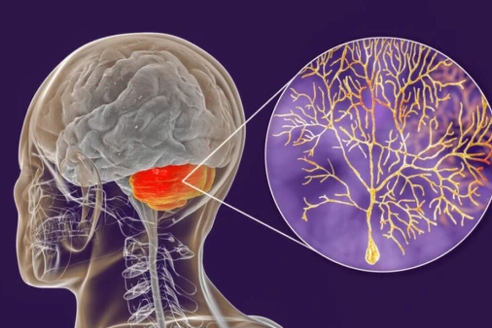 Sensory Atoxia Surgery