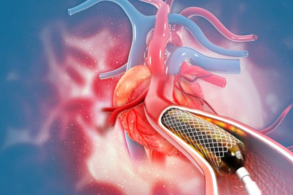 Sensory Ataxia Venous Angioplasty Surgery: Procedure, Benefits & Recovery