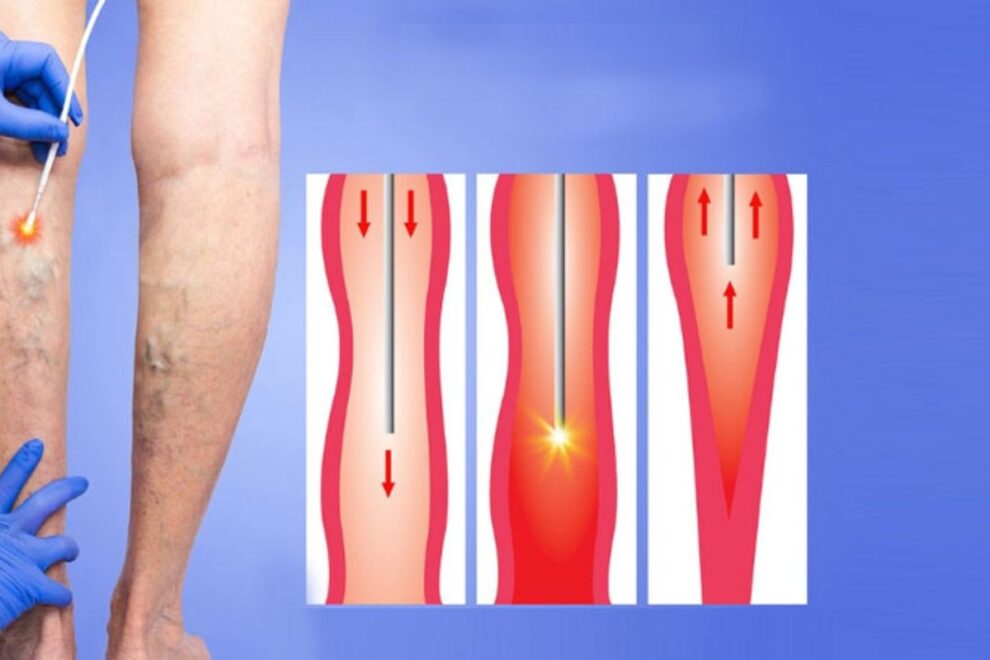 Spider Veins Surgery in India: Advanced Treatments for Vein Removal