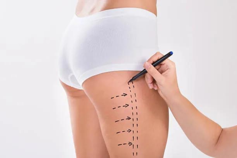 Thigh Liposculpture