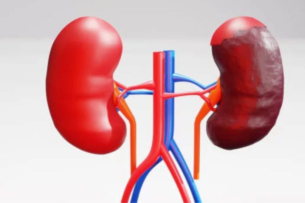 Affordable Radical Nephrectomy in India: Top Hospitals & Surgeons