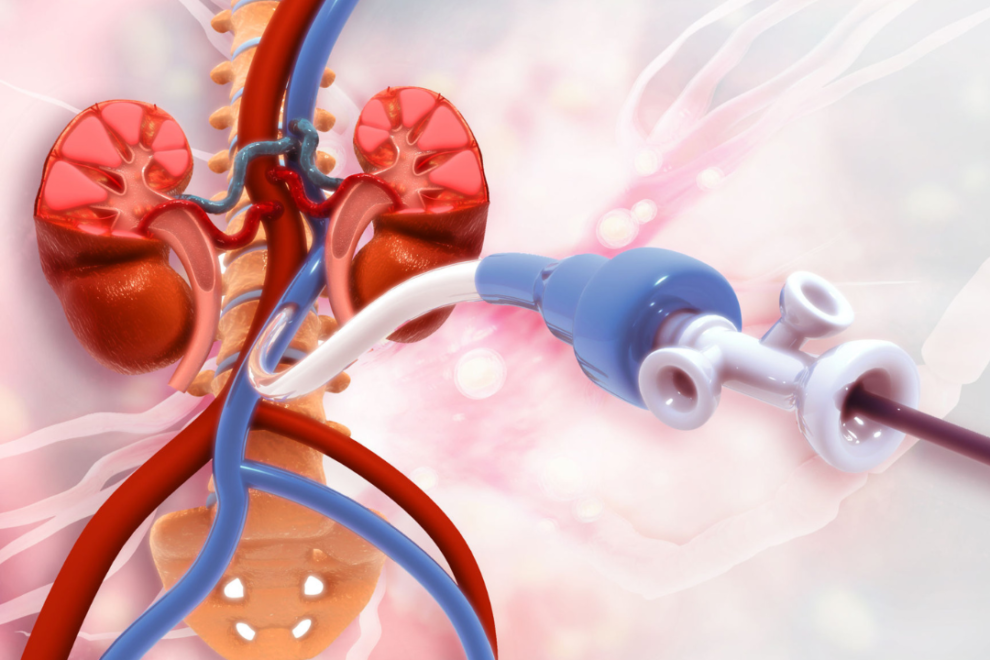 Femoral Embolectomy in India
