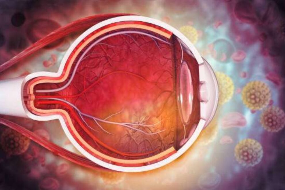 Laser Iridotomy Surgery in India Effective Treatment for Glaucoma