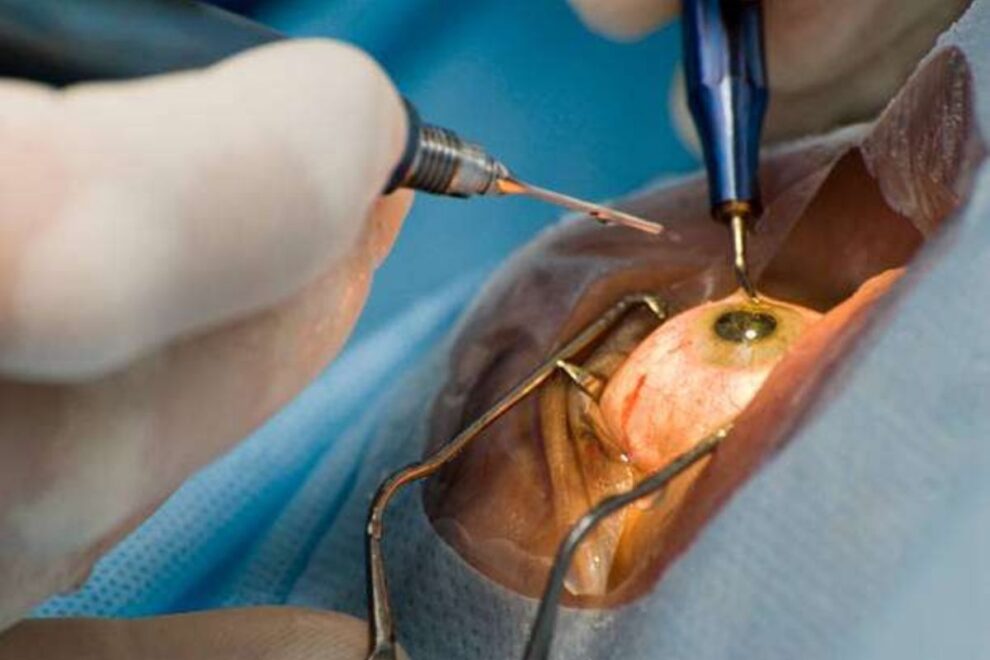 Laser Peripheral Iridotomy in India