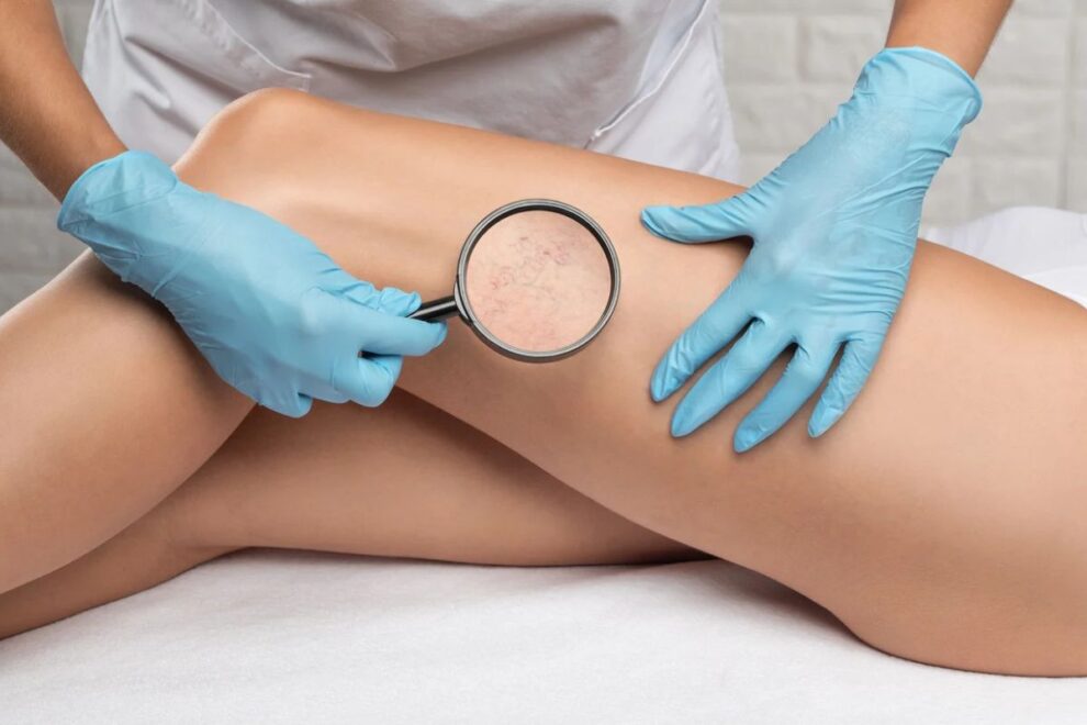 Laser Spider Vein Treatment in India Effective Solutions for Varicose Veins