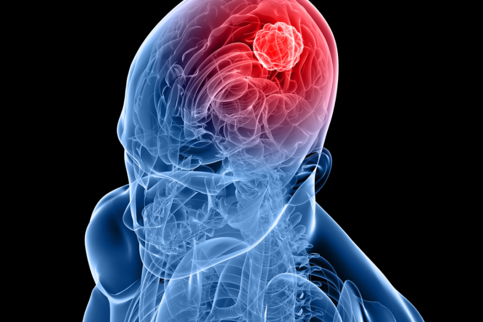 Metastatic brain tumors