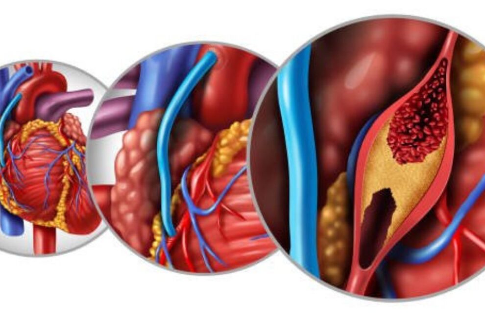 Open Heart Bypass Surgery in India: Top Hospitals & Surgeons