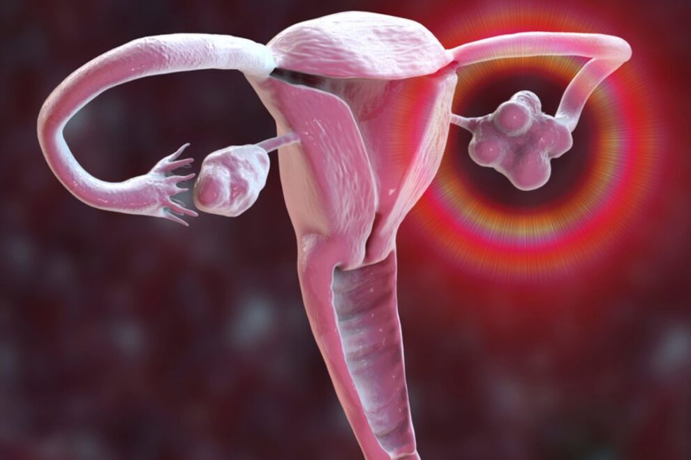 Ovarian Drilling Treatment in India: Effective Solutions for PCOS