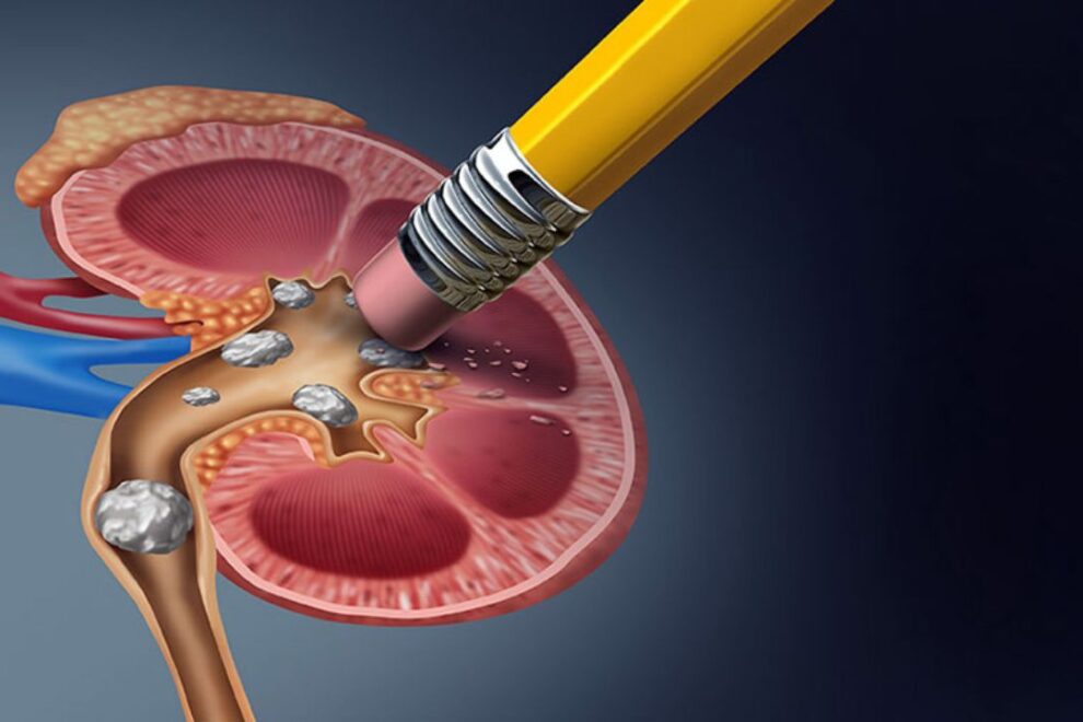 Pcnl Surgery in India: Affordable Kidney Stone Removal Treatment