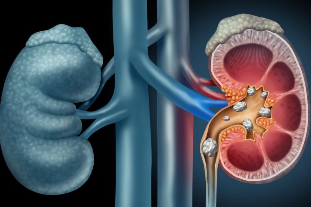 Percutaneous Nephrolithotomy Surgery in India: Advanced Kidney Stone Removal