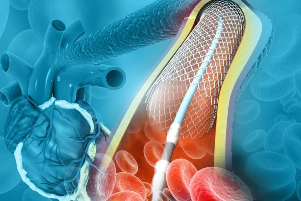 Peripheral Angioplasty Surgery in India: Cost, Benefits & Top Clinics