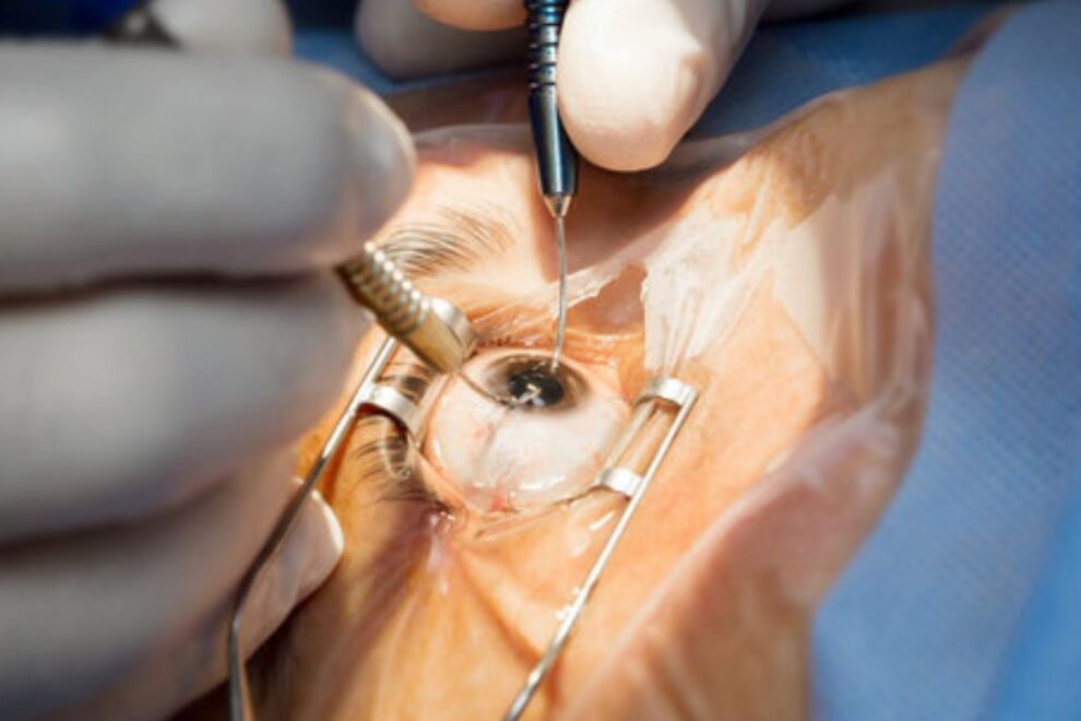 Phacoemulsification in India: Advanced Cataract Surgery Techniques