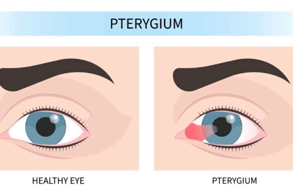 Pterygium Removal Surgery in India: Safe & Effective Eye Treatment