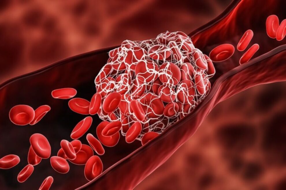 Pulmonary Embolism Surgery in India: Cost, Procedure, and Success Rates