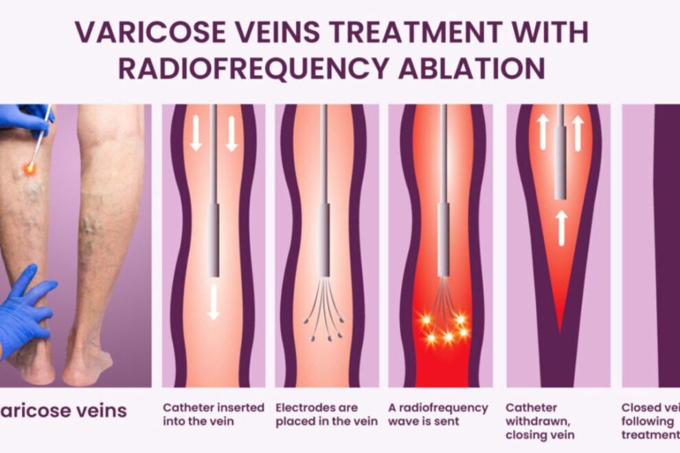 R F Ablation Surgery: Procedure, Benefits & Recovery