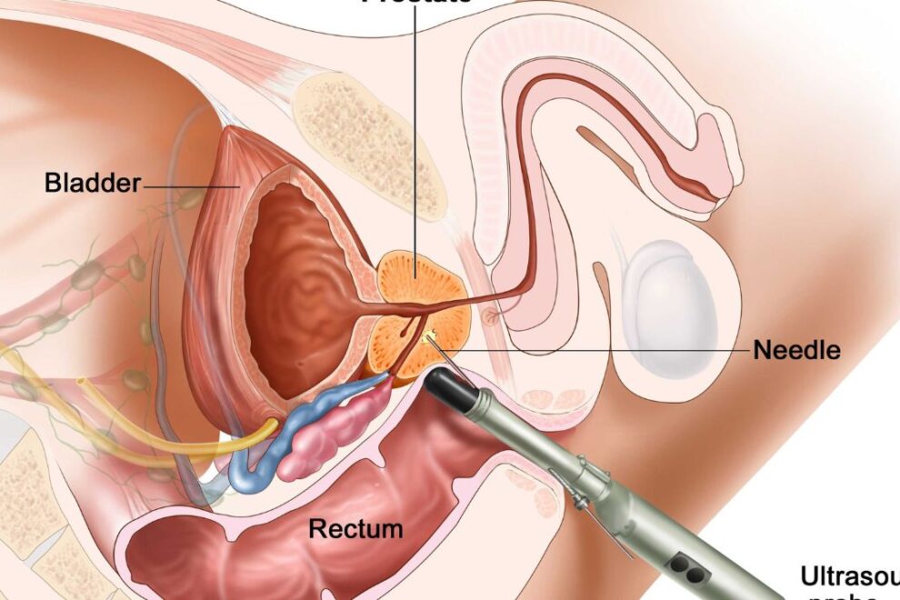 Radical Prostatectomy Surgery in India: Affordable Prostate Cancer Treatment