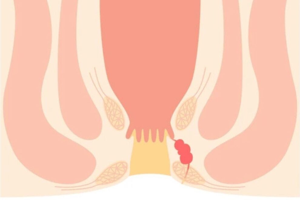 Anorectal Conditions Treatment