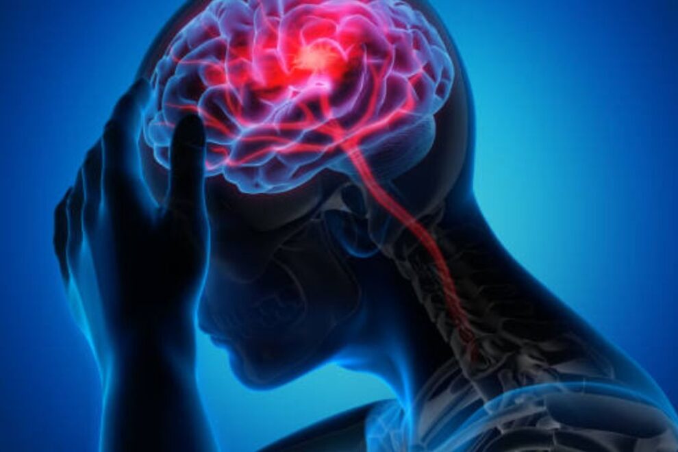 Brain Stroke Treatment In India 2024