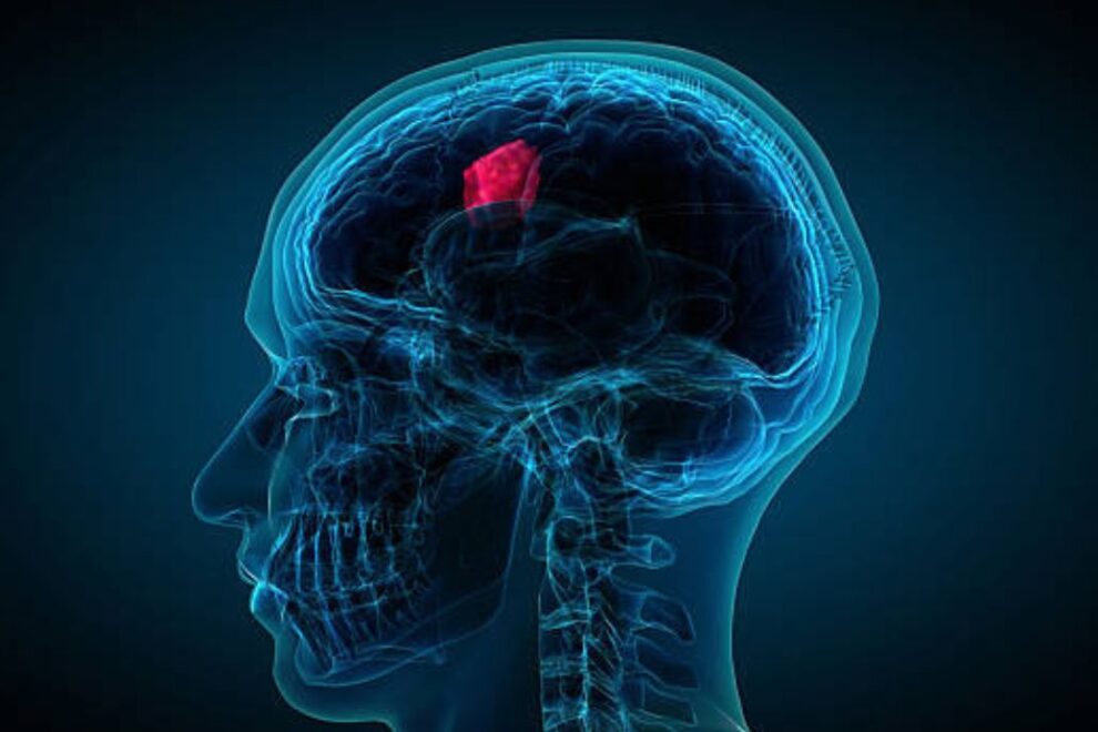 BrainTumor In India Types and Causes