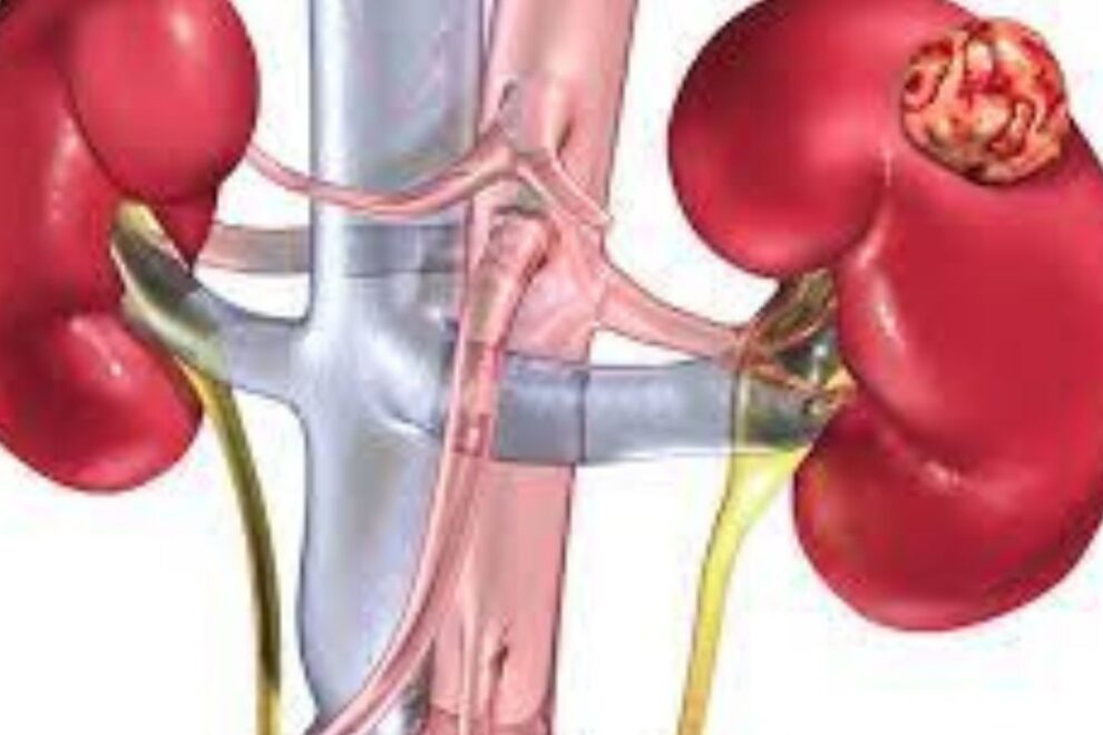 Kidney Cancer Treatment in India Advanced Oncolog