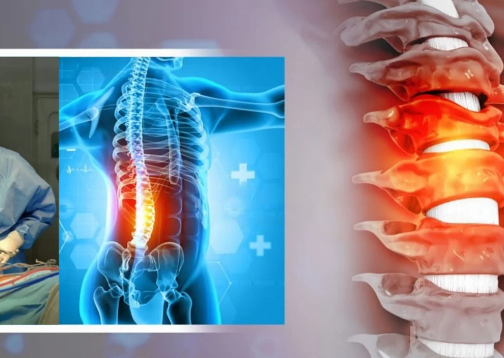 Micro Lumbar Discectomy Surgery in India