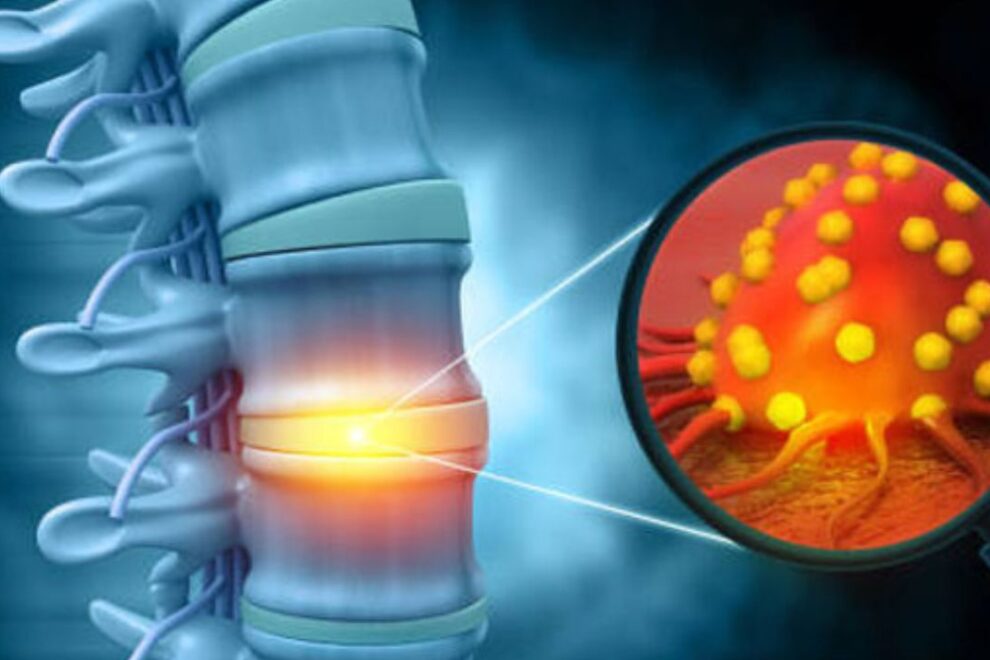 Musculoskeletal Cancer Treatment in India (1)