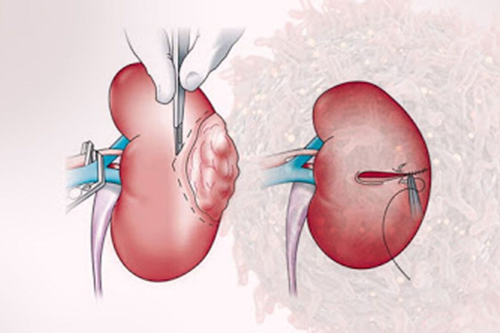 Uro-Oncology Treatment in India (1)